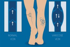Φλεβική ανεπάρκεια: Αίτια και συμπτώματα